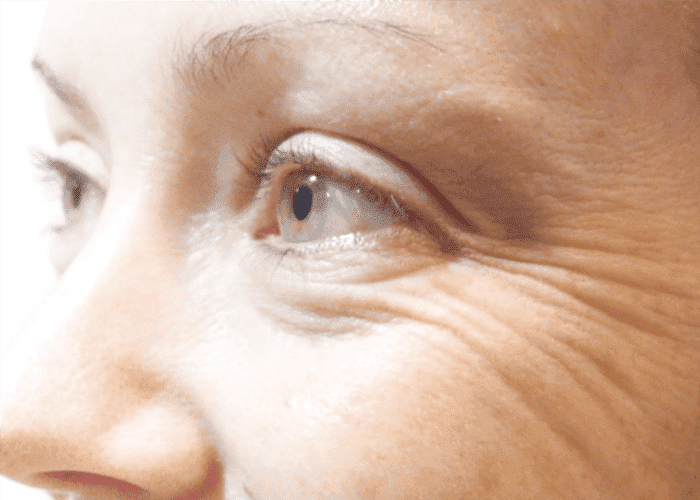 Как уменьшить мимические морщины на лице и вокруг глаз? | Evolution