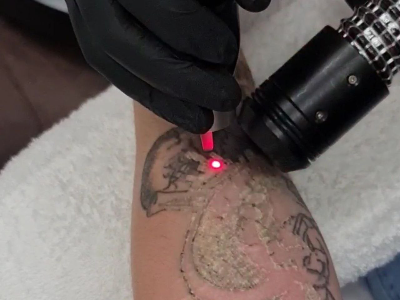 Как вывести тату: методы и способы удаления татуировок лазером?