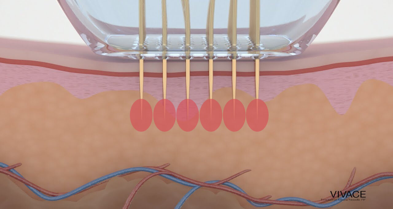 Микроигольчатый RF-лифтинг