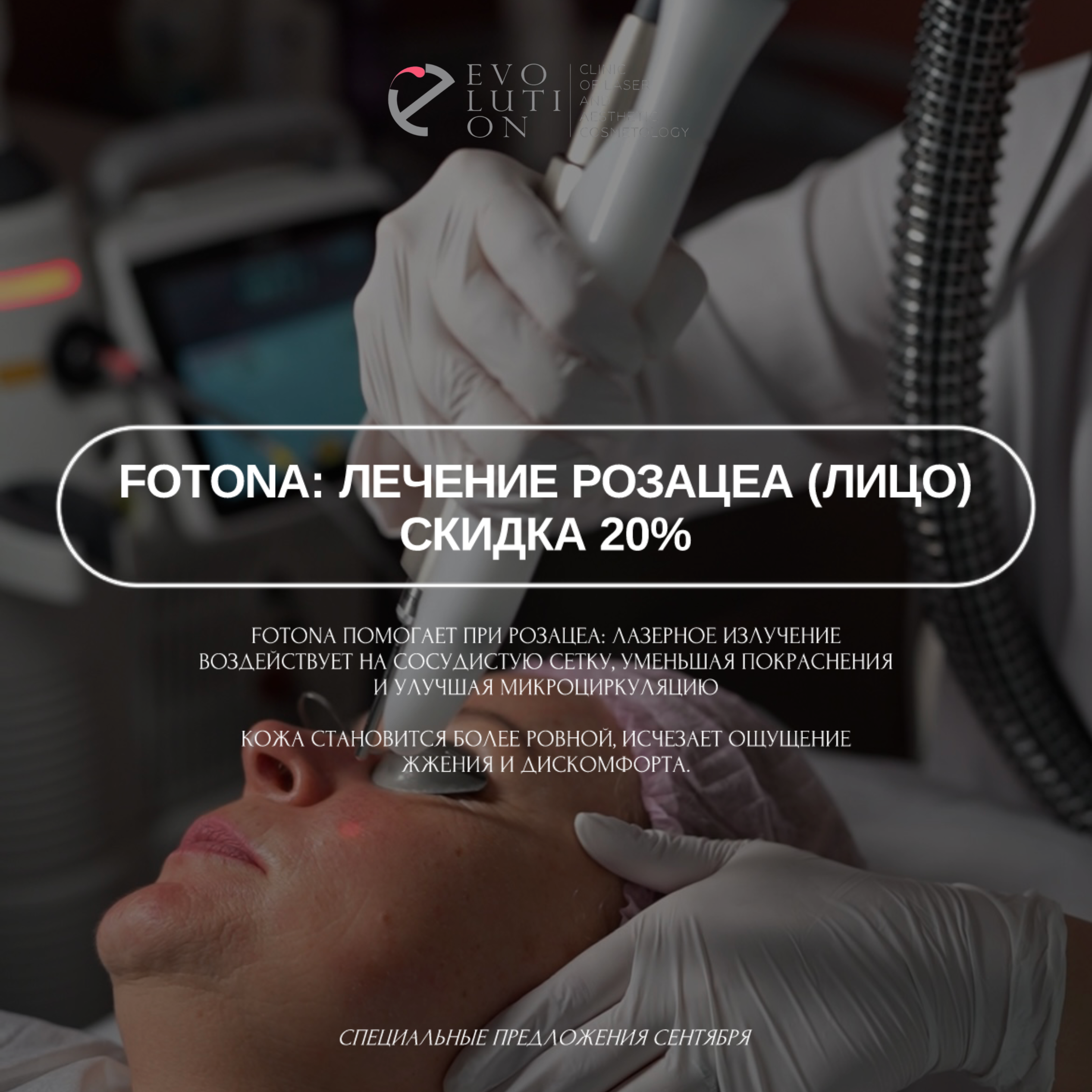 Fotona: лечение розацеа (лицо) -20%