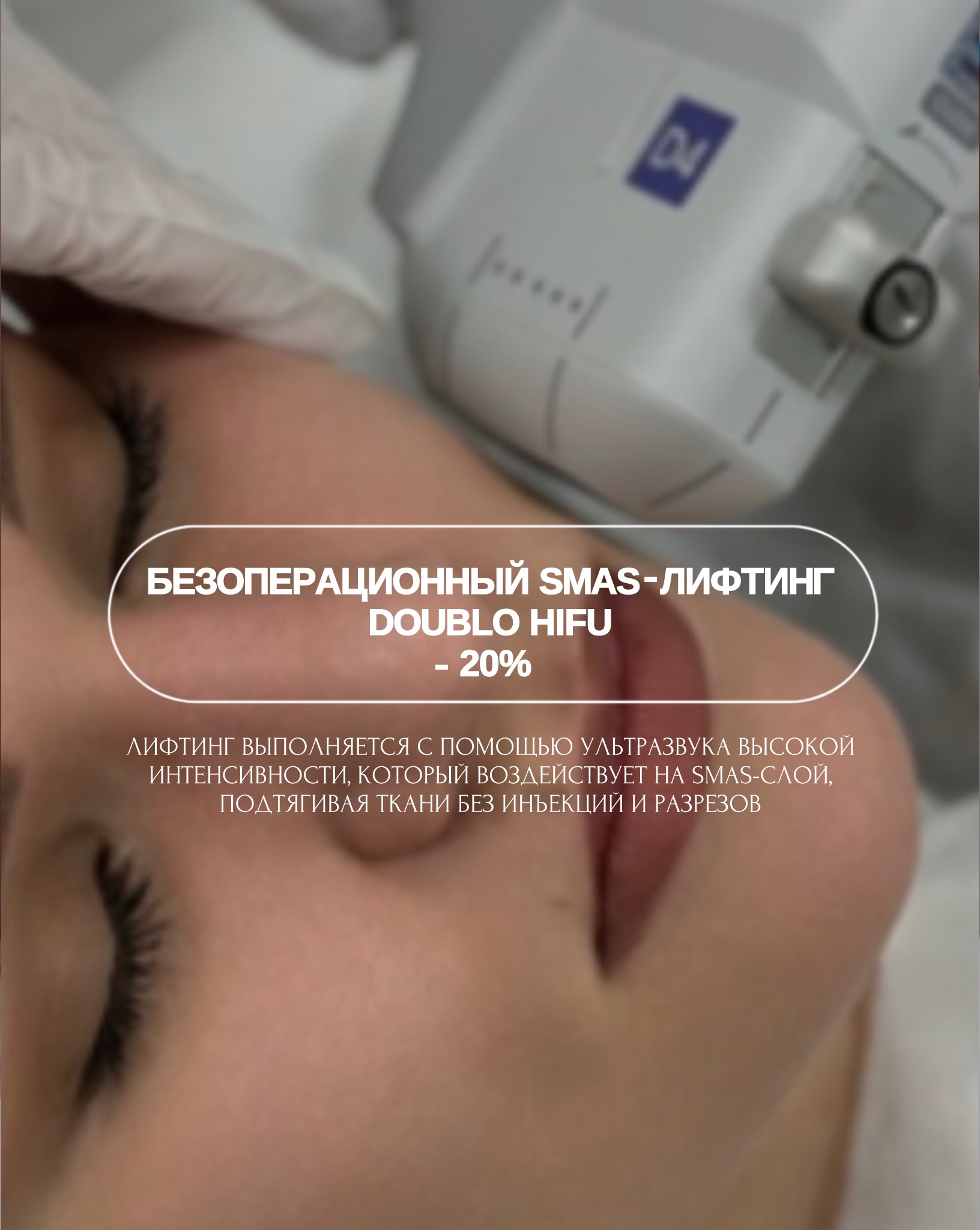 Безоперационный SMAS-лифтинг Doublo HIFU со скидкой 20%