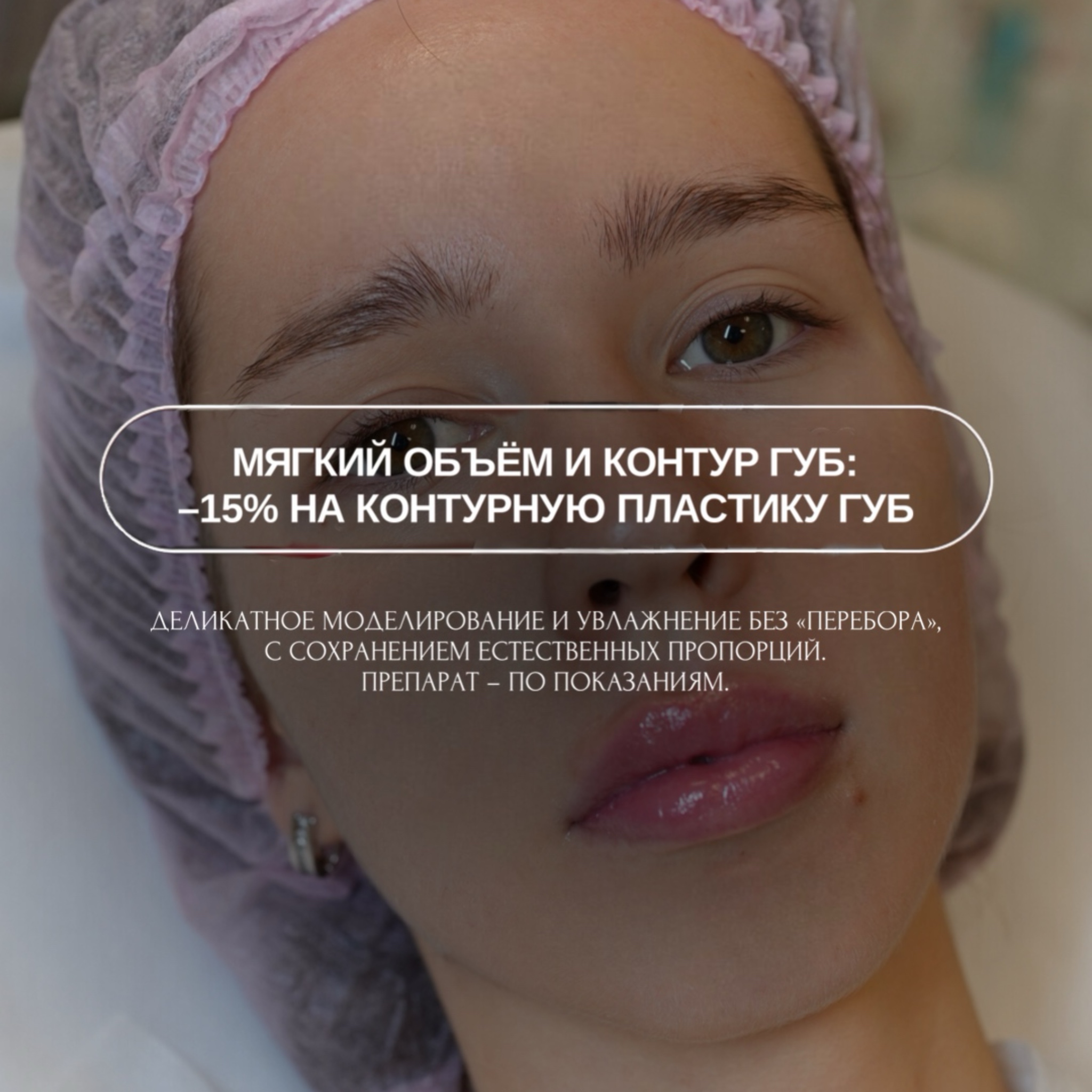 Мягкий объём и контур губ — скидка 15% на контурную пластику губ