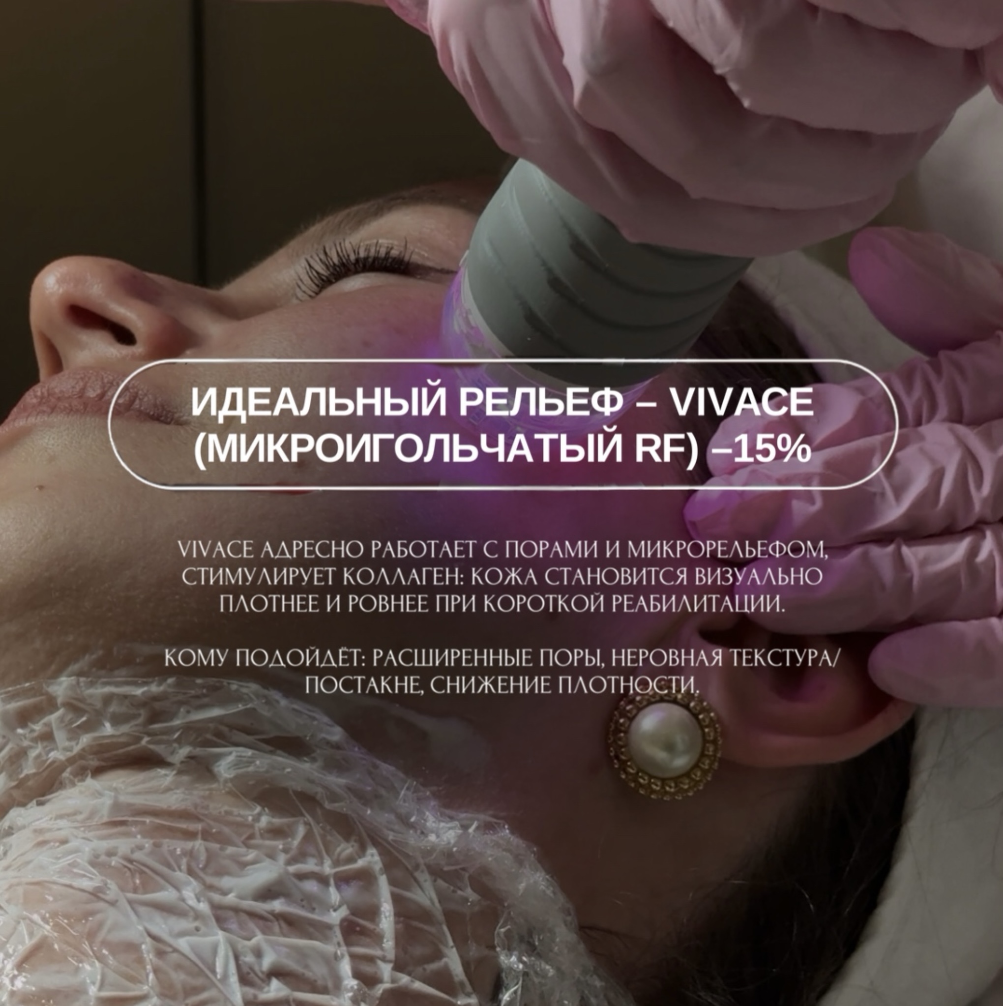 Идеальный рельеф — Vivace (микроигольчатый RF) −15%