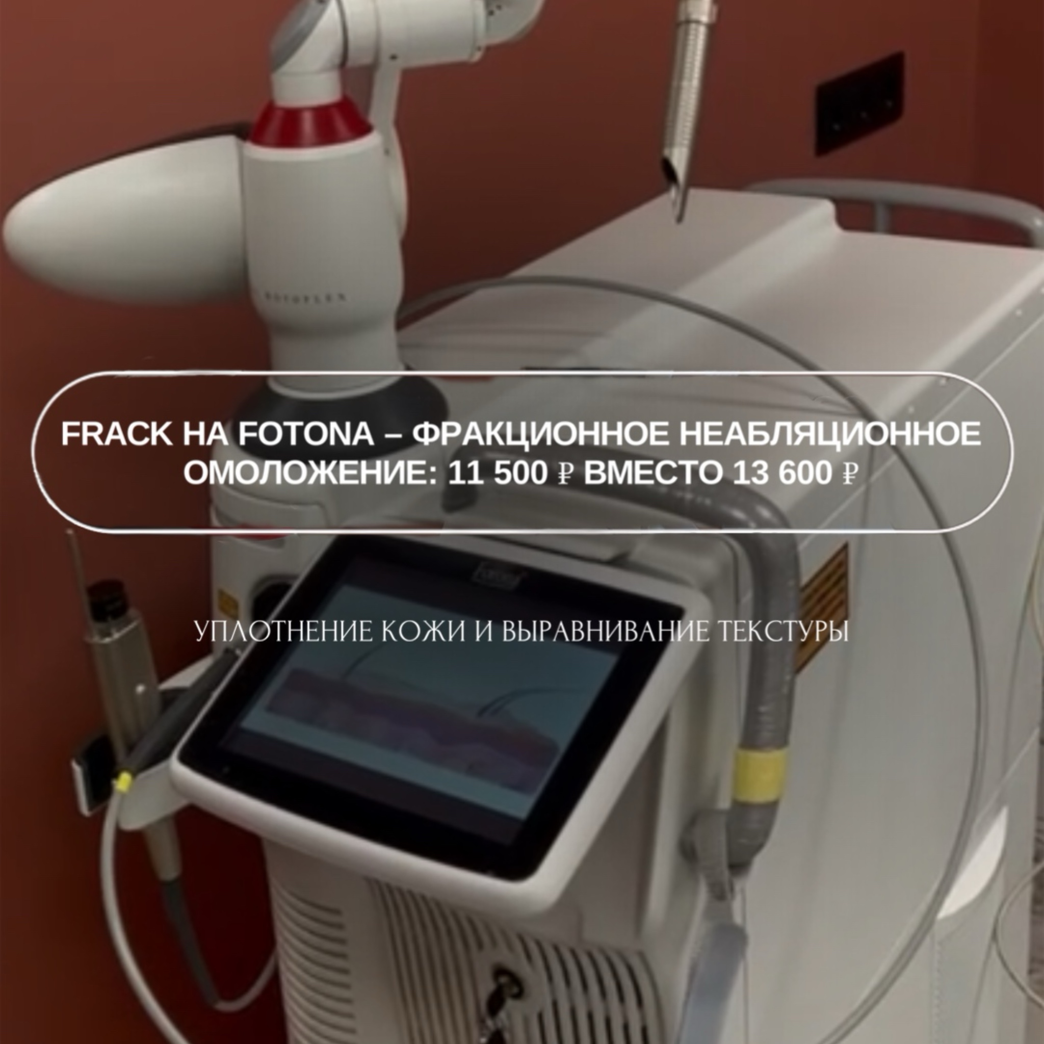 Программа фракционного неабляционного омоложения FRAC3 на аппарате Fotona